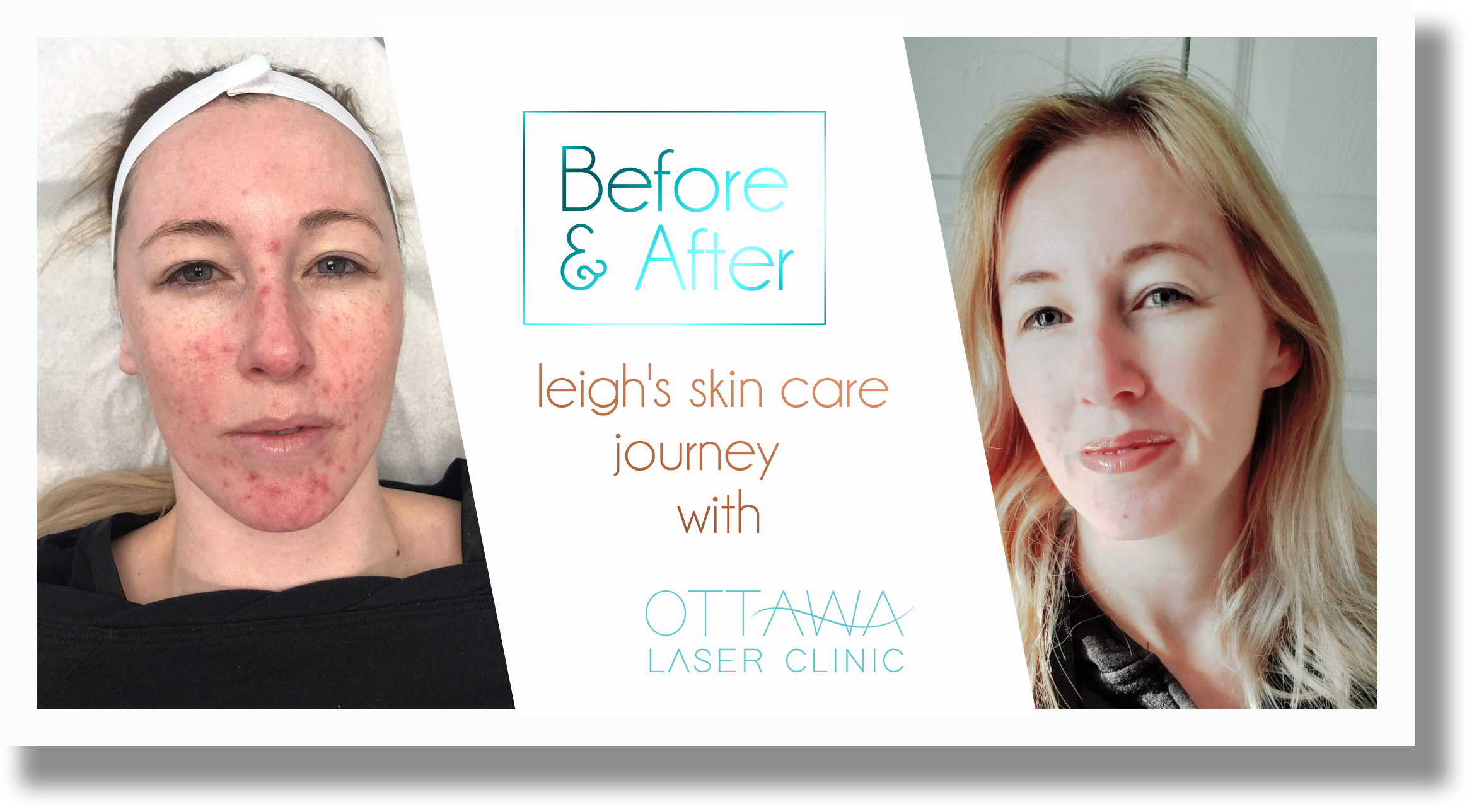 Leigh's Skin Care Journey - Ottawa Laser ClinicOttawa Laser Clinic