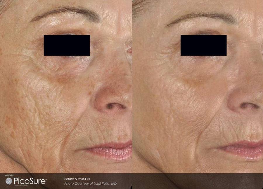 State-Of-The-Art Skin Rejuvenation at Ottawa Laser ClinicOttawa