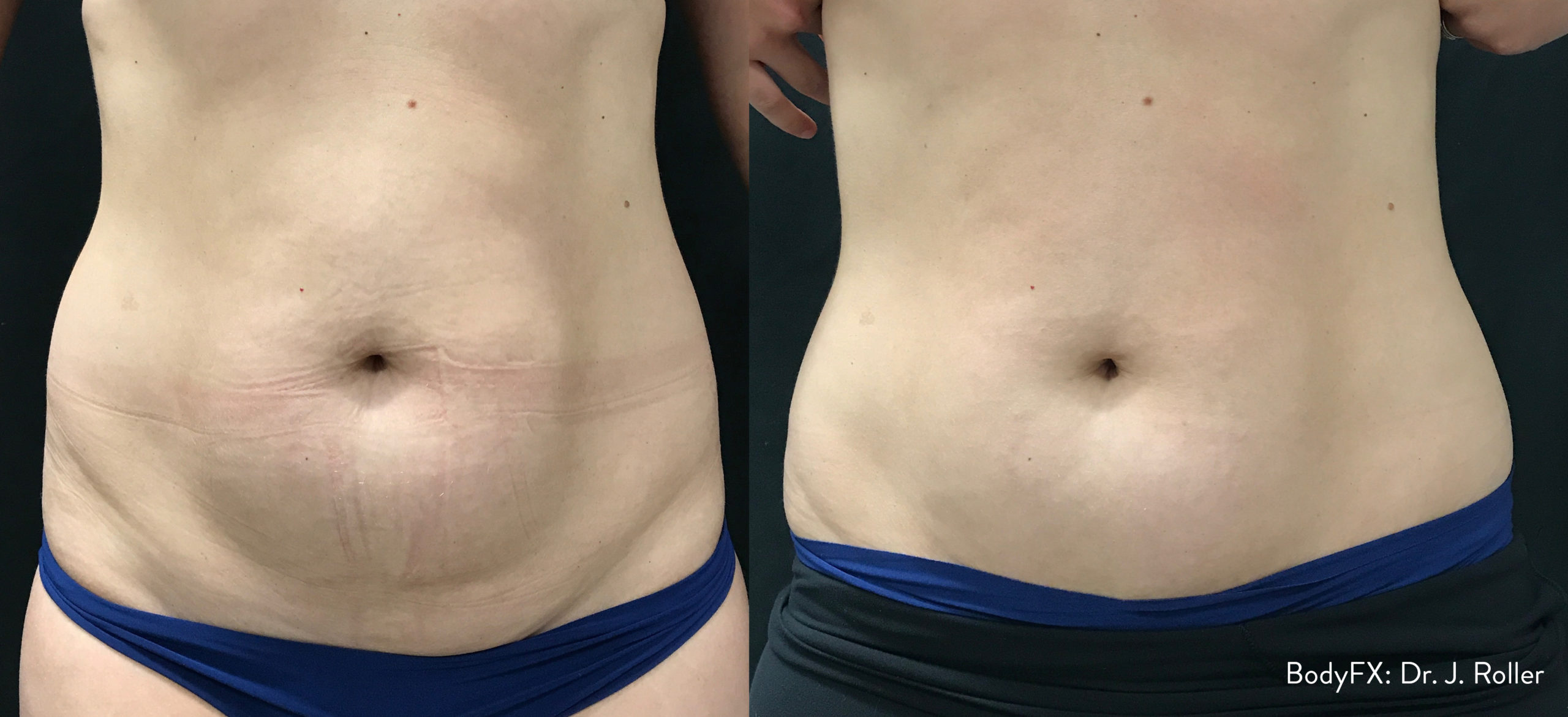 What is Body Contouring?  Allure Enhancement Center