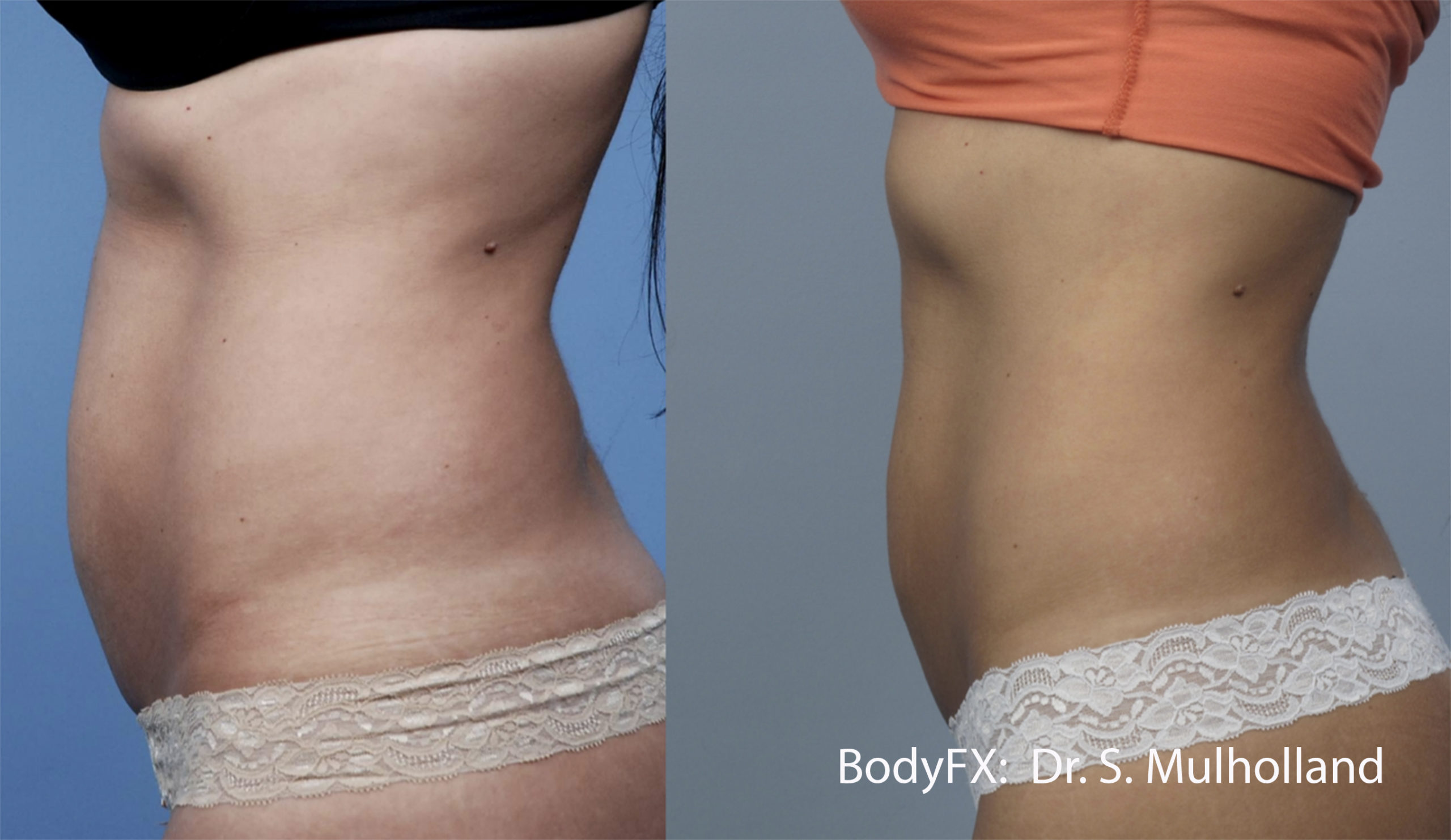 How Modern-Day Body Contouring Treatments Overtook Surgical